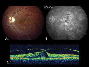 tomografia optica coherente oct en retinopatia diabetica